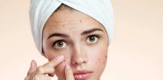 Acne Vulgaris Scarring