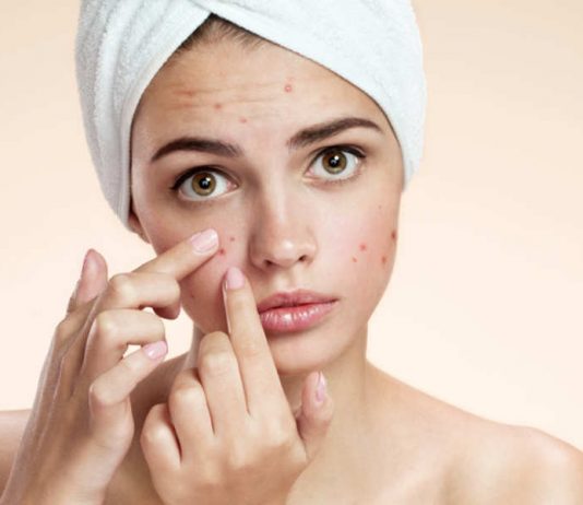 Acne Vulgaris Scarring